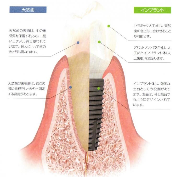 インプラント治療について