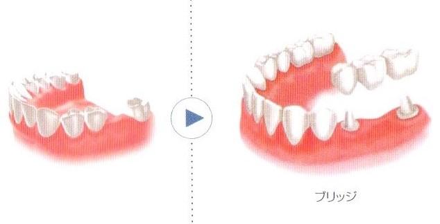 従来の治療方法とインプラント治療の比較