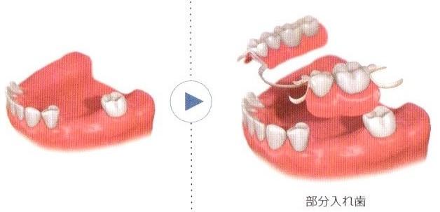 従来の治療方法とインプラント治療の比較