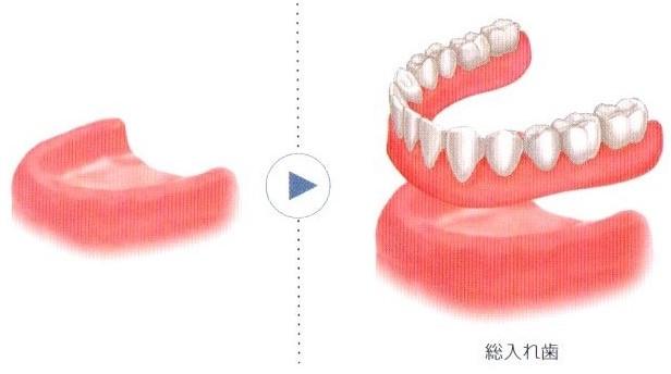 従来の治療方法とインプラント治療の比較