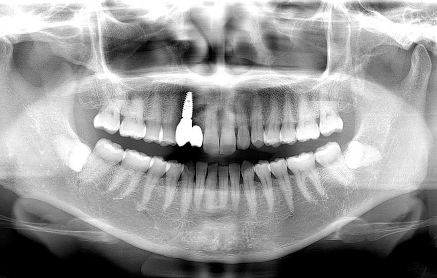 >インプラントによる治療の症例1