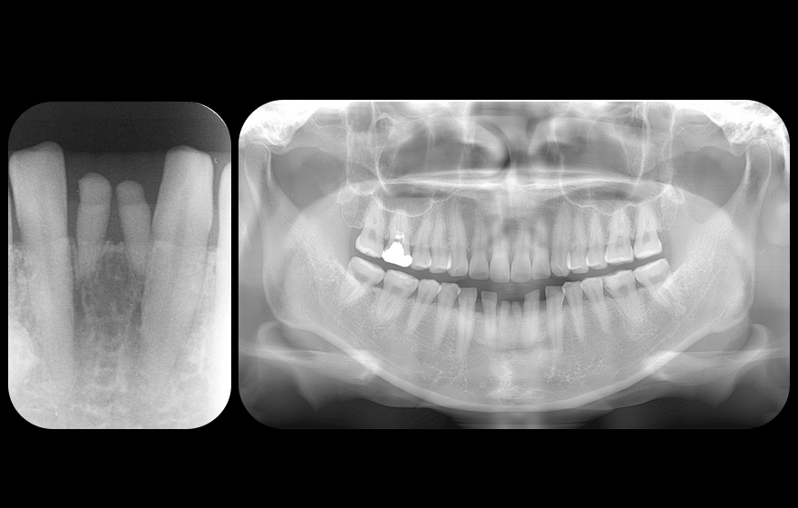 >インプラントによる治療の症例2