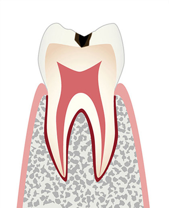 C1エナメル質の虫歯