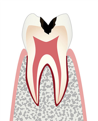 C2 象牙質の虫歯