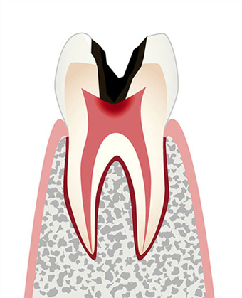 C3　歯髄の虫歯