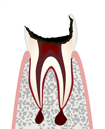 C4 歯髄が壊死した虫歯