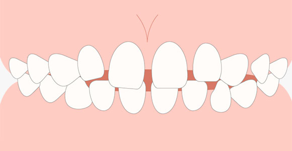空隙歯列